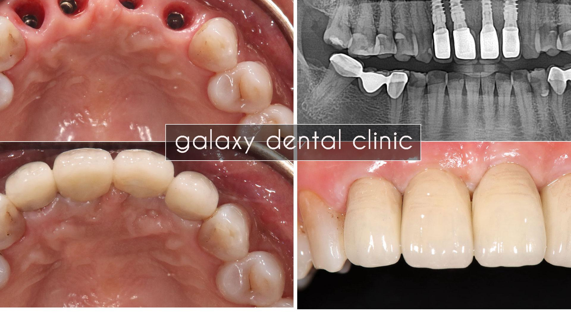 galaxydentalcliniccayghepimplanttronglai4rangcuabimatbsmung