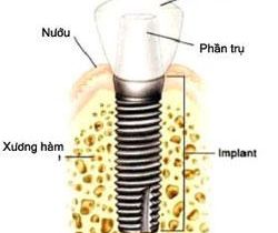 Cấy ghép implant là gì?