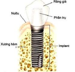 Cấy ghép implant là gì?