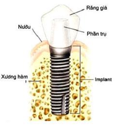 Cấy ghép implant là gì?